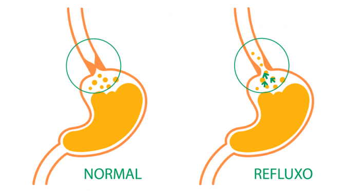 Você tem refluxo? Confira 5 dicas de como evitar