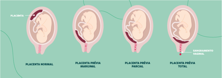 O que é placenta prévia? Obstetra destaca 3 riscos para mãe e bebê