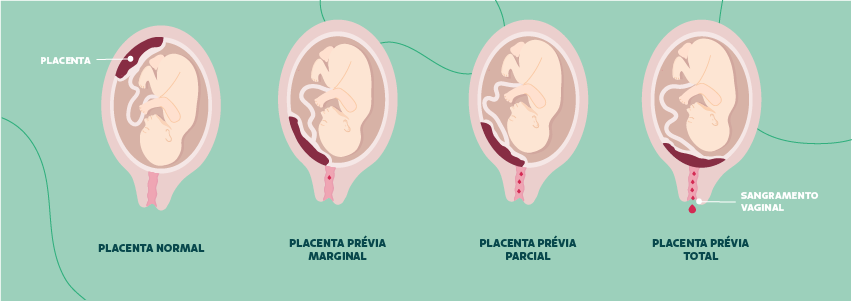 classificacao da placenta previa